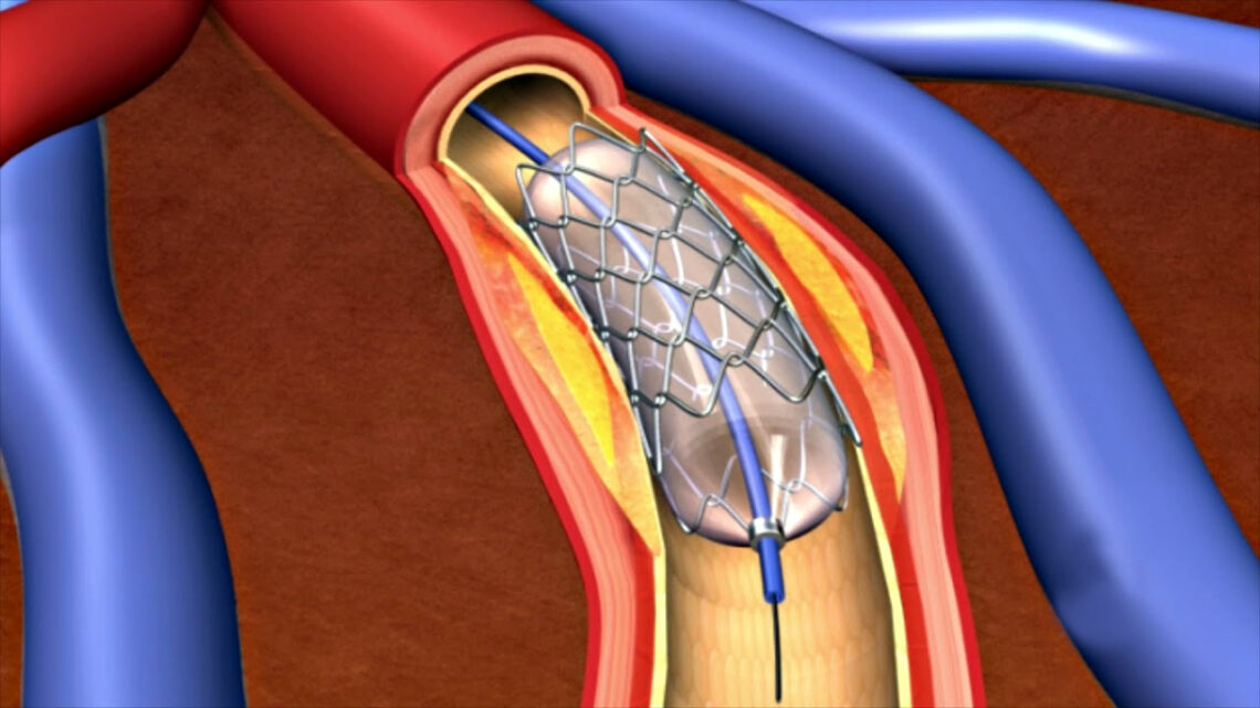 Glimmer of hope for heart patients: Centre notifies coronary stents as `Essential Medicine’