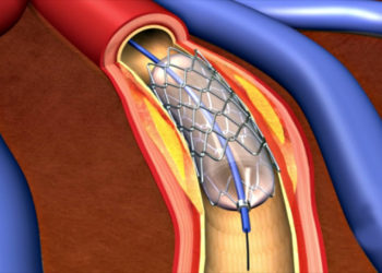 Glimmer of hope for heart patients: Centre notifies coronary stents as `Essential Medicine’