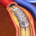 Glimmer of hope for heart patients: Centre notifies coronary stents as `Essential Medicine’
