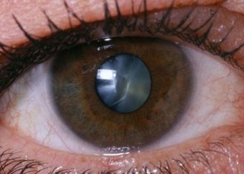 J&K Reports Rise In Cataract Cases, 6,000 Surgeries In 10 Months