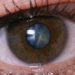 J&K Reports Rise In Cataract Cases, 6,000 Surgeries In 10 Months