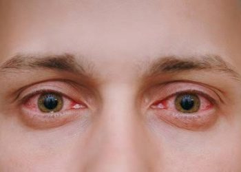 Around 15,000 Cases Of ‘Eye Flu’ In J&K