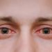 Around 15,000 Cases Of ‘Eye Flu’ In J&K