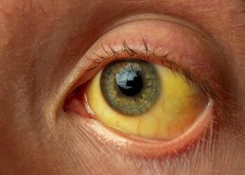 27 Test Positive for Jaundice in South Kashmir’s Anantnag, Probe Team Formed