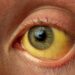 27 Test Positive for Jaundice in South Kashmir’s Anantnag, Probe Team Formed