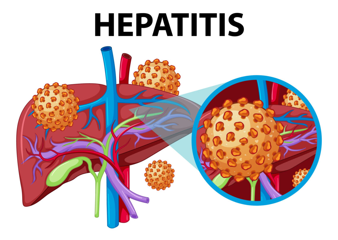 Hepatitis Outbreak Among Children Reported In Srinagar